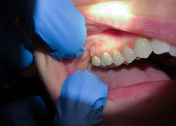 Best Emergency Treatment for Dental Infections or Abscesses in Mansfield, TX